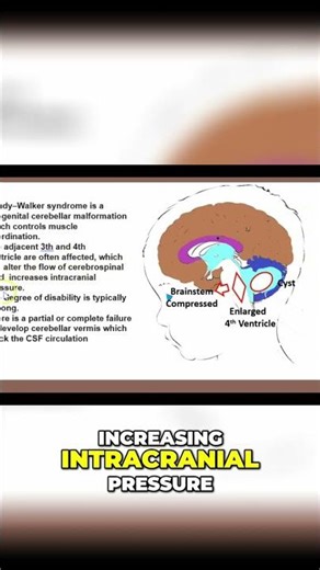 Dandy-Walker Syndrome: Causes, Symptoms, and Treatment #shorts
