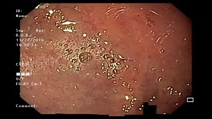 3 comments | ¡Endoscopia!  Procedimiento utilizado para visualizar el tubo digestivo. Menciona situaciones en las que lo utilizarías #gastroenterologia #medicosdecorazon | Médicos de Corazón | Facebook