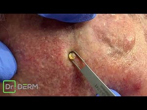 | Dr. Derm - Dave & Dave Summer Edition - Blackheads