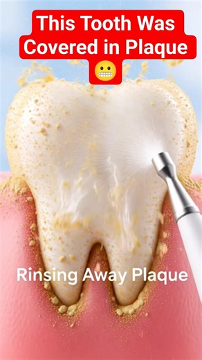 This Tooth Was Covered in Plaque 😬#plaque#dentalcleaning#satisfying#teethcleaning#tooththerapy