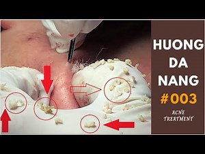 #003 | Nhat part 1 | Super squeeze acne asmr | Yêu nặn mụn | trattamento acne