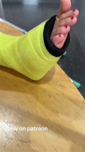 #gipsbein #cast #gips #platre #legcast | gps