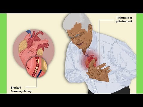 Widowmaker heart attack: Everything you need to know.