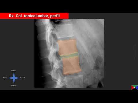 El foramen intervertebral en imágenes