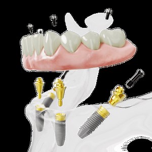 All-on-4 Dental Implants in Hyderabad, India | Treatment Cost at FMS