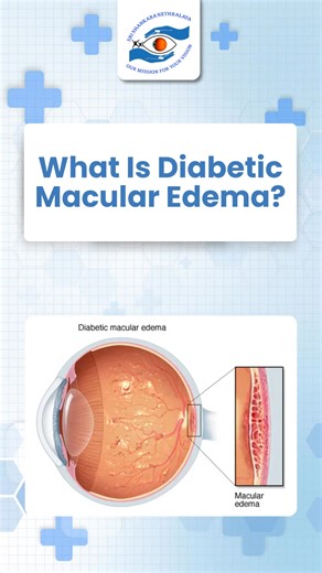 Sri Shankara Nethralaya on Instagram: "Diabetic Macular Edema (DME) is a serious complication of diabetes that leads to fluid buildup in the retina. If you're noticing blurred vision or "wavy" lines, it’s time for a check-up. Early detection at Sri Shankara Nethralaya can save your sight. Warning Signs: Blurred central vision, faded colors, or dark spots. Action: Schedule your comprehensive eye exam today. #SriShankaraNethralaya #DME #DiabeticRetinopathy #EyeHealth #DiabetesCare"