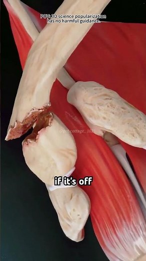 How a Broken Collarbone Is Repaired (3D Animation)