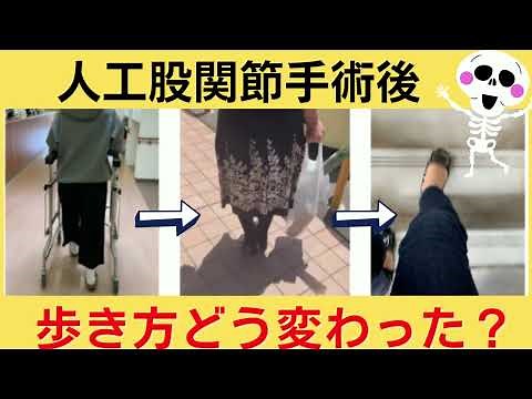 【人工股関節手術】術後歩き方が激変！こつ然と痛みが消えて歩き始めた