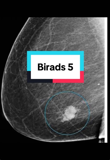 BI-RADS 5 means the radiologist sees a finding on breast imaging that looks highly suspicious for cancer. It doesn’t confirm cancer yet, but the chance is very high, usually over 95%. Because of that, the next step is almost always a biopsy to get a tissue sample and make the final diagnosis.