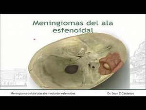 Meningioma del ala lateral y media del esfenoides