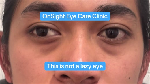 Effective Vision Therapy for Exotropia