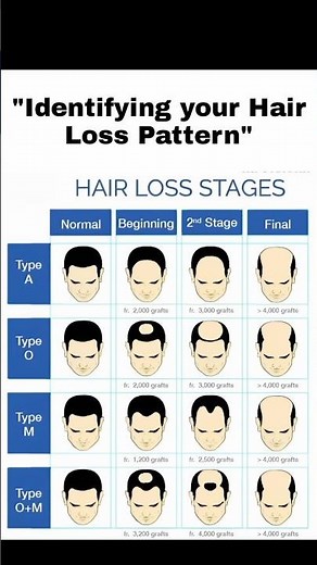 Hair Loss Stages Explained: Identify Baldness Type and Treatment Options