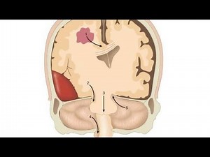Brain Edema or Cerebral Edema ; Definition, Causes, Symptoms, Diagnosis, Treatment