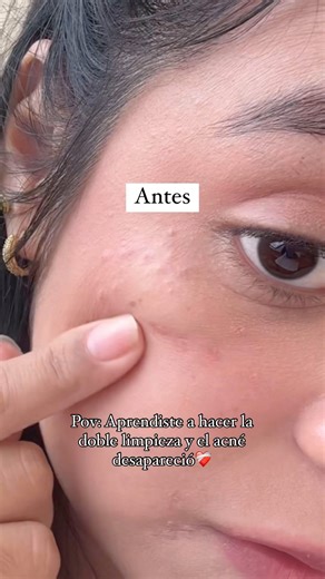 Nataly Cordova Palomino on Instagram: "La vida cambia cuando aprendes a hacer la Doble Limpieza y más usando @mixsoon_official ❤️‍🩹 #acne #acné #acnetreatment #fungalacne #fungalacnesafe #doblelimpieza #doublecleansing #doublecleanse #centella asiática #centella #skin1004 #cleansingoil #cleansing #acne #fypシ #fypシ❤️💞❤️ #xybca #girlpower #girls"
