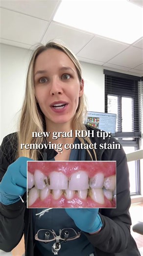 Effective Tips for Removing Teeth Stains from Contacts