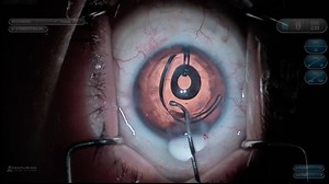 IC-8 Pinhole Lens in a Post-PKP Patient - Eyetube