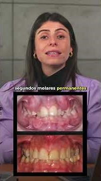 ¿Debemos tratar la mordida profunda en niños? 🤔