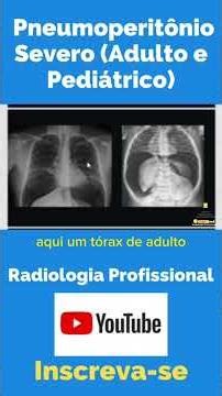Pneumoperitônio Severo Adulto e Pediátrico #shorts