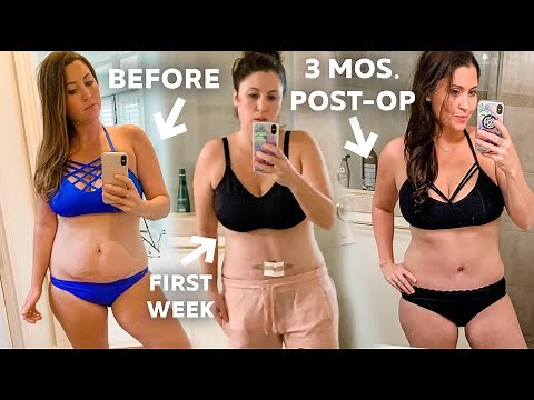 Tummy Tuck (3 Month Post op) Update!! Before and After In Pictures - Mommy Makeover