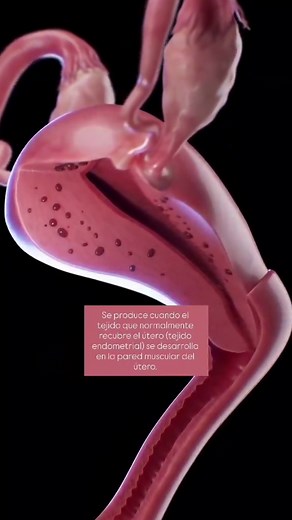 Adenomiosis: Síntomas y Tratamientos Efectivos
