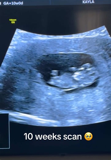 Understanding Your Baby's Development at 10 Weeks