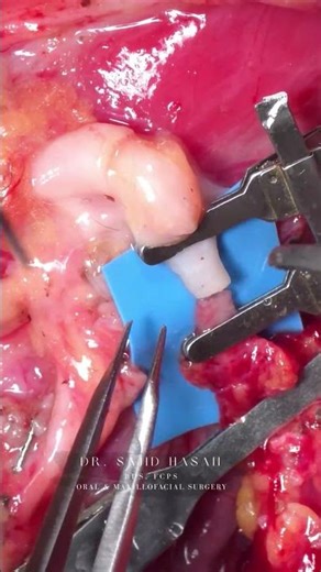 Microvascular Surgery #doctor #dentist #dentalartistry #tissuerepair #reconstructivesurgery