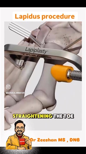 Dr Zeeshan on Instagram: "🪀 All about Lapidus procedure 🔴 Se the video👉 Org Vid- surg animation 🫡 #drzeeshanorthosurgeon #punjab #ludhianaorthopaedicsurgeon #malerkotlaorthopedicsurgeon #lapidusprocedure"