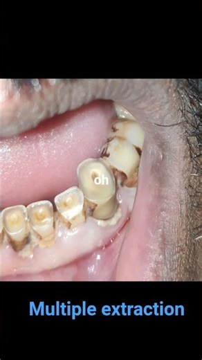 #dentist #smiledesigndental #dentalclinic #teethclinic🦷✨⚡🎉💫 multiple extraction