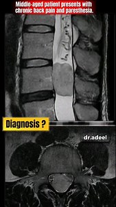 Diagnosis Challenge: What’s the Spine MRI Showing? Description Middle-aged patient presents with chronic back pain and paresthesia. MRI spine shown — look carefully at the level, cord signal, and canal compromise. 📌 What is your diagnosis? Drop your answer before scrolling 👇 ✅ Diagnosis: Myxopapillary Ependymoma Location: Filum terminale / conus medullaris MRI: T1 iso, T2 hyper, vivid enhancement, well-defined Diff: Schwannoma (nerve root origin), Meningioma (dural tail), Astrocytoma (intramed