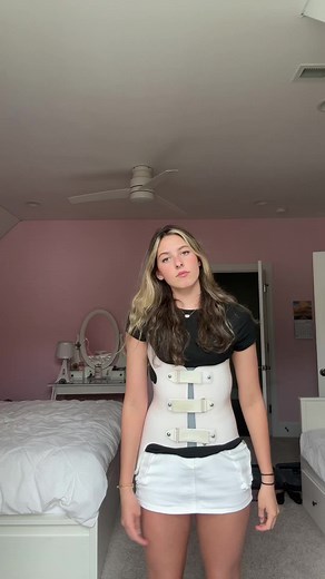 Scoliosis Awareness: Understanding the Milwaukee Brace