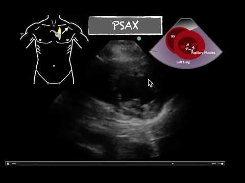 POCUS Cardiac PSAX Normal EF