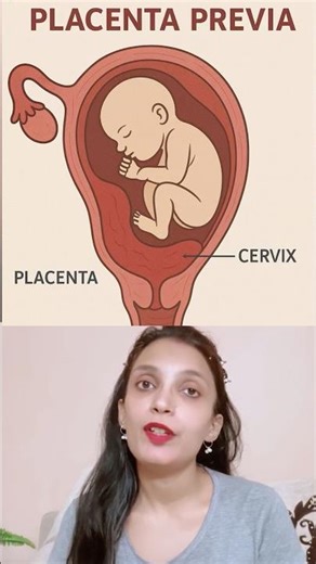Placenta previa in pregnancy #shortvideo #placentaprevia