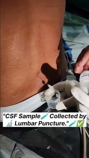 csf collection method in Select hospital #DrAmirAIIMS #NeuroOT #OperationTheatre #HospitalLife