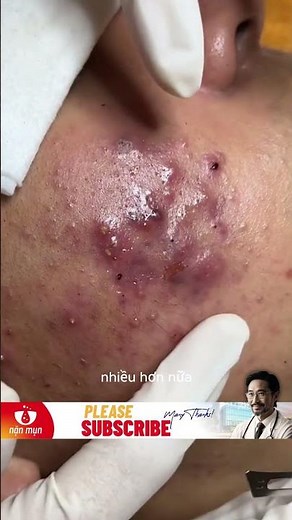 [S43] SQUEEZING ACNE "BLACKHEADS" AND "WHITEHEADS" FAST AND EFFECTIVE | ACNE SQUEEZING FAST & EFF...
