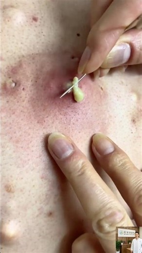 Giant Pimple Popping Extreme