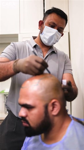 How Clinics Map Your Perfect Hairline #hairtransplant #beforeandafter #technique