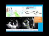 A Simple Transesophageal Echocardiography Quiz and Introduction to Tee Views (Toe) • Video • MEDtube.net
