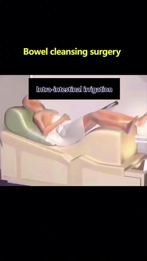 #foryou #surgery #medical #bowel #cleansing #body #intestines #fypシ