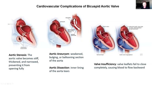 From Whole-Exome Sequencing to Functional Dissection of a Single-Nucleotide Variant in Bicuspid ... | Dovetail Genomics