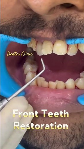 Fixing Chipped Front Teeth in Minutes #dentist