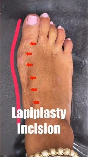 Lapiplasty™ vs MIS bunion Surgery #shorts
