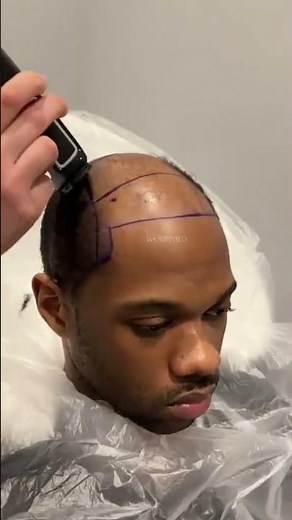 Afro Hair Transplant in Turkey | Black male hair transplant