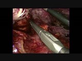Hand Assisted Laparoscopic Splenectomy With Multiorgan Resection • Video • MEDtube.net
