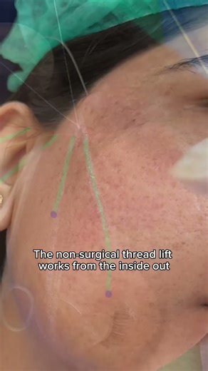 Thread lift: The 15 min facelift.