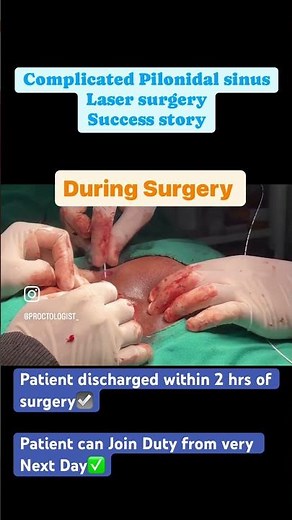 Pilonidal sinus successful laser surgery by Dr Saurabh Patel Proctologist