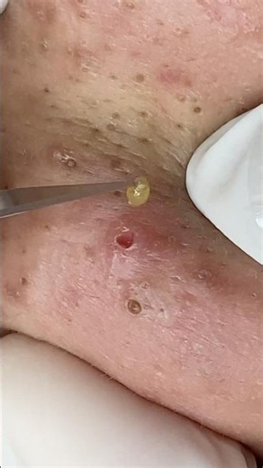#blackheads #sacdepspa #treatments