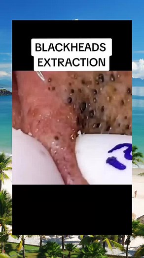 squeeze popping acne extraction pimple blacheads viral (9)