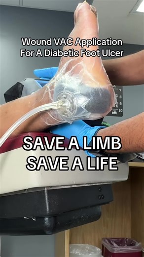 Wound VAC Application #podiatry #woundcare #woundvac #savealimbsavealife