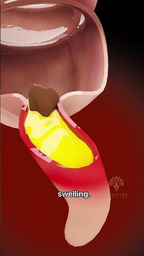 How Appendicitis Happens | appendix symptoms #shorts - creativelearning3d