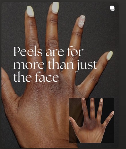 Dark knuckles? We’ve got the solution. ✨ The Perfect Derma™ Peel isn’t just for the face — it’s the only medical-grade peel on the market infused with Glutathione, the master antioxidant that brightens, repairs, and protects your skin. 💙 Core Ingredients: ✔ Glutathione – reverses skin damage & brightens tone ✔ Kojic Acid – fades stubborn hyperpigmentation ✔ TCA, Retinoic & Salicylic Acid – smooth & renew skin texture ✔ Vitamin C – boosts collagen & glow 📌 Important: This treatment can ONLY be 